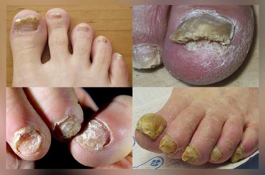 Как за лечение на напреднали гъбички по ноктите Гъбички по ноктите на пръстите на краката лечение лекарства напреднали