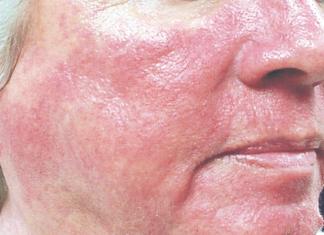 Какво да направите, ако лицето ви е напукано, как да възстановите кожата си у дома?