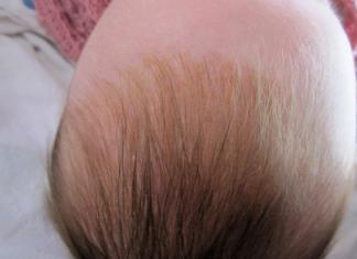 Crusts on the head of newborns: causes and how to remove them