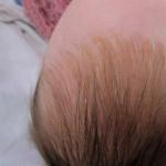 Krusty na hlave novorodencov: príčiny a ako ich odstrániť