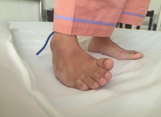 Detská ortopédia: problémy s nohami Kedy navštíviť lekára